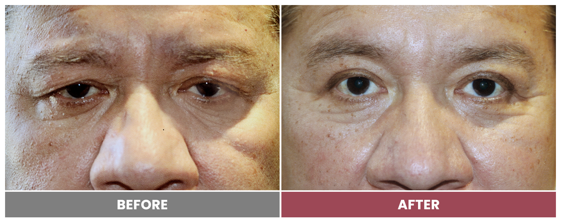 Upper Blepharoplasty - Case 5